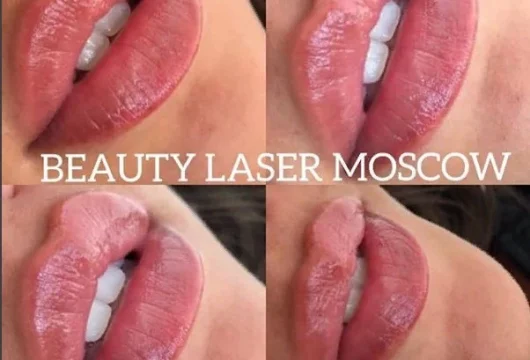 косметология бьюти лазер фото 4 - liftinglica.ru