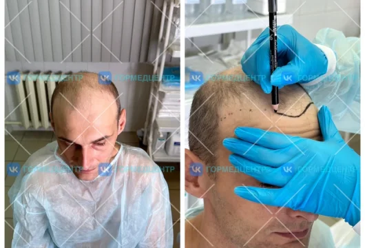 клиника гмц пересадка волос фото 17 - liftinglica.ru