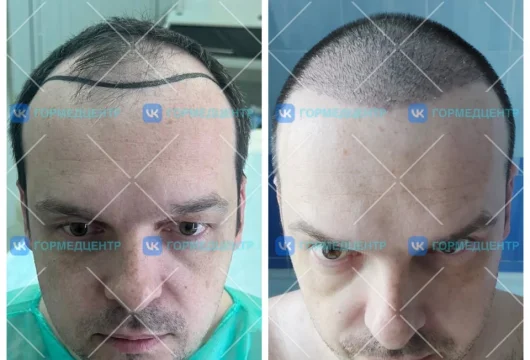 клиника гмц пересадка волос фото 18 - liftinglica.ru