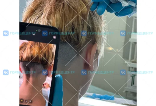 клиника гмц пересадка волос фото 6 - liftinglica.ru